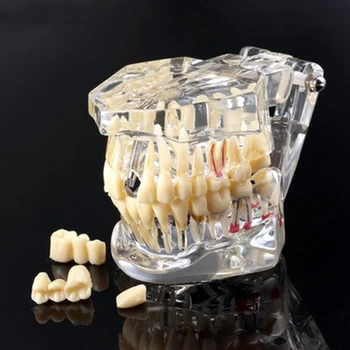 Zobni Patologija Zob Model Poučevanja Medicinske Zob Zobozdravstvo Vsadek Obnova Mostu